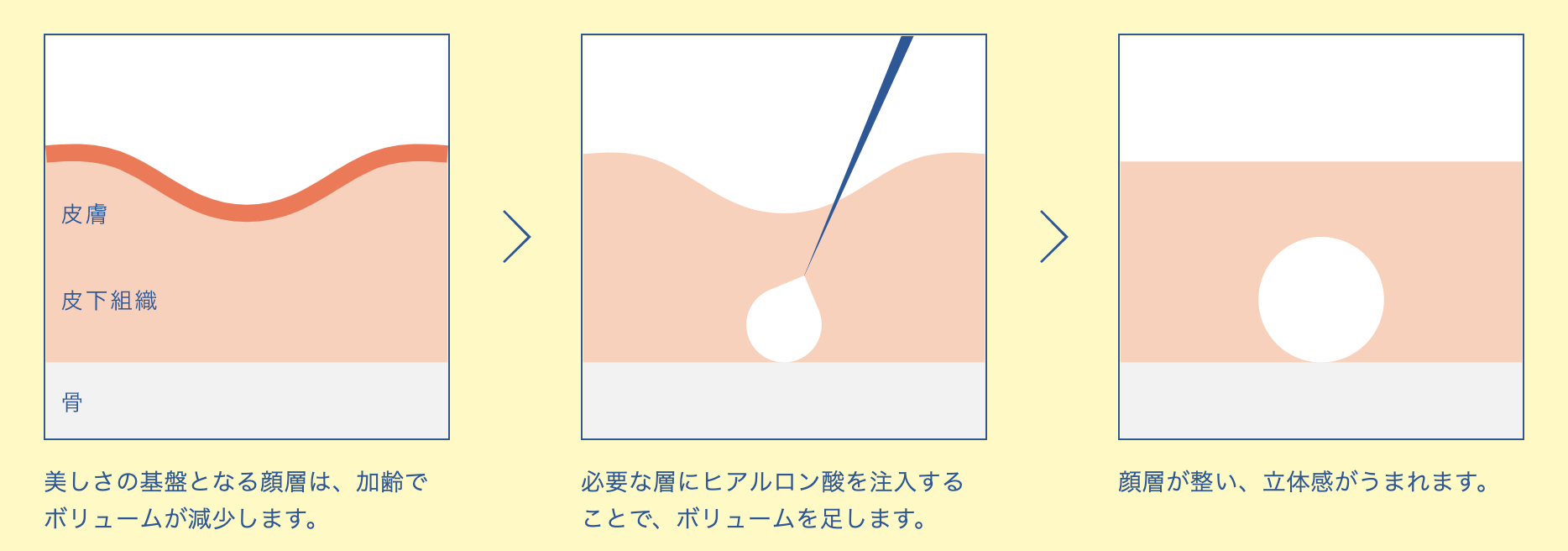 ヒアルロン酸02