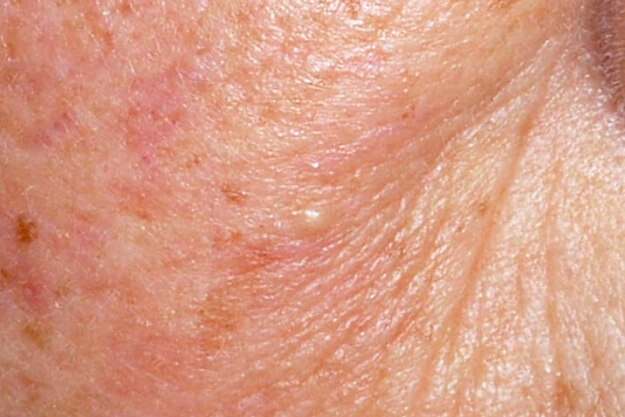 稗粒腫の症状例