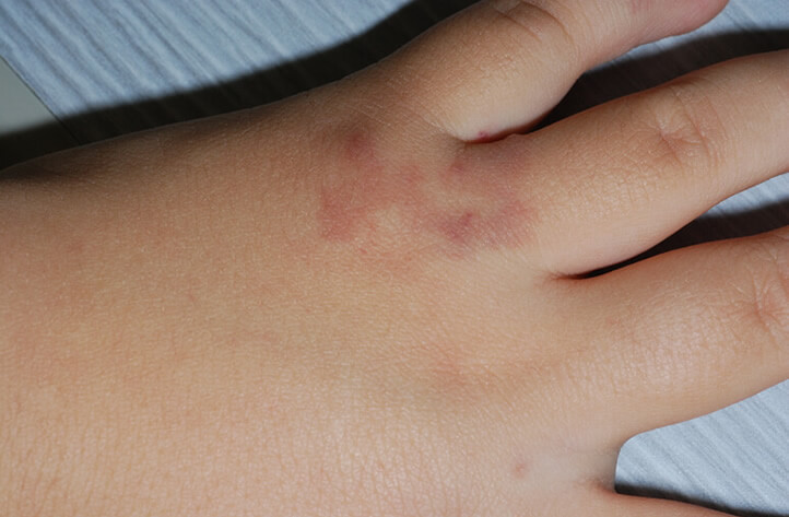 単純血管腫の症状例