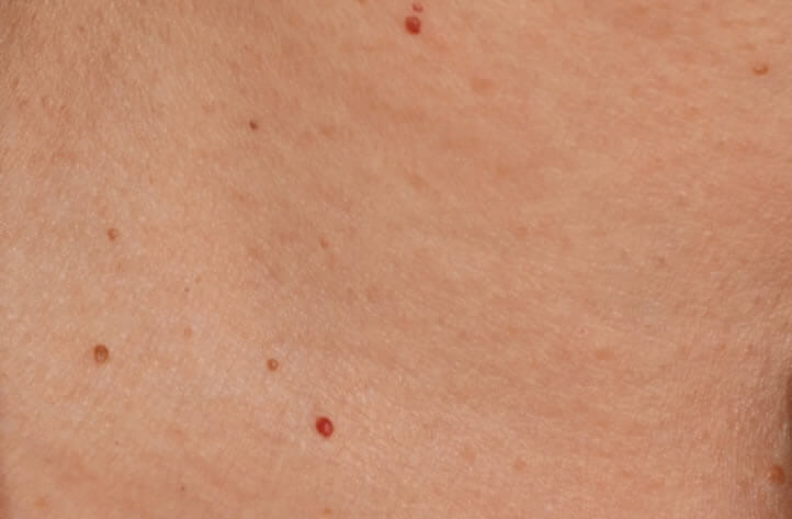 老人性血管腫の症状例