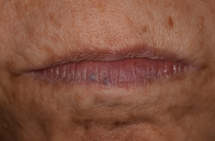 静脈湖の症状例