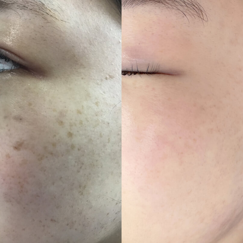 シミレーザー治療