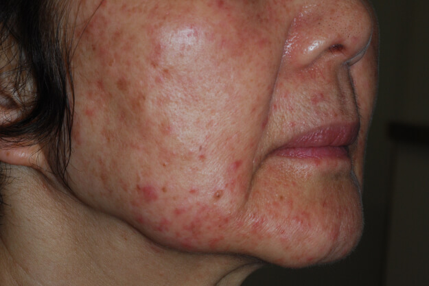 毛穴のポツポツの症状例