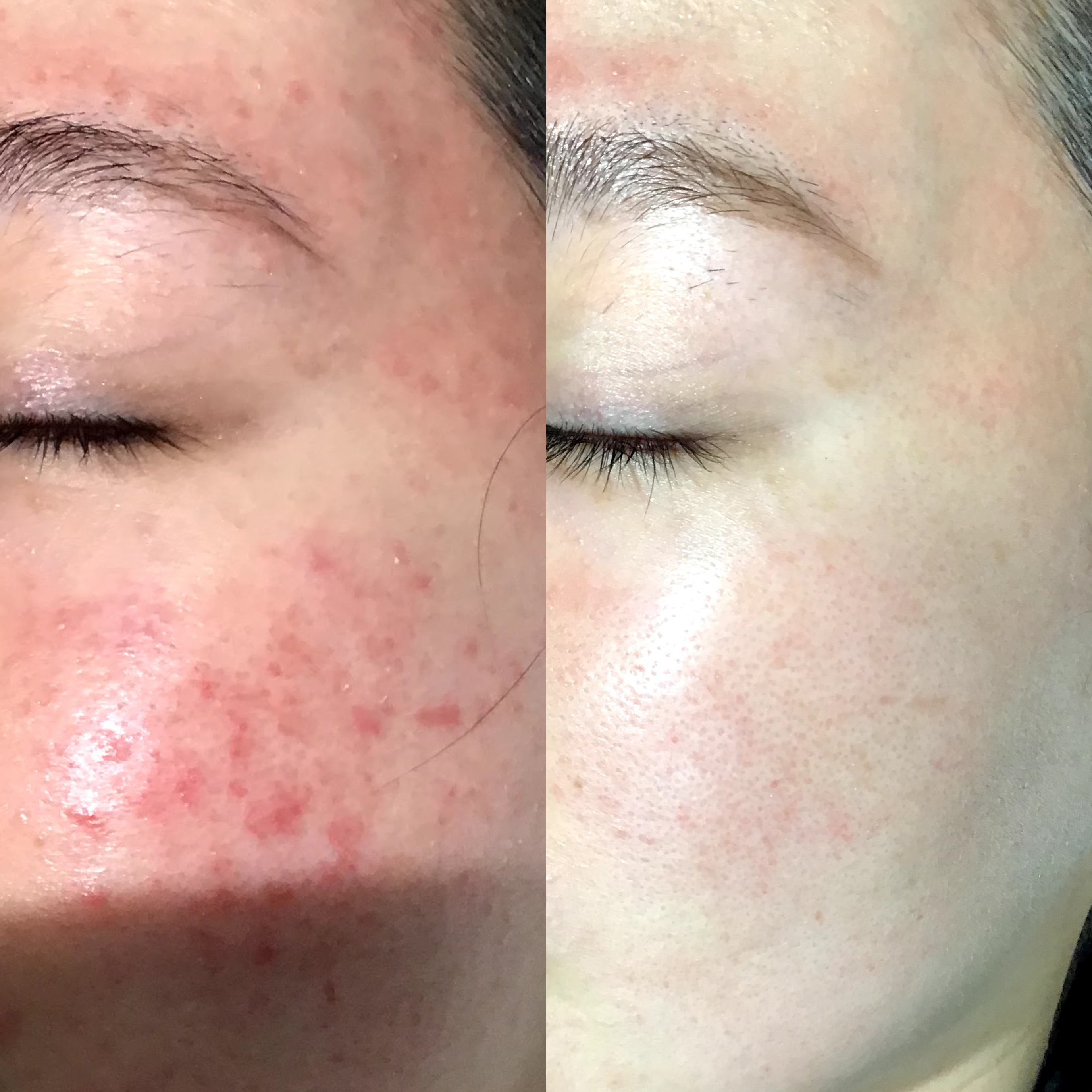 赤ら顔の症状例