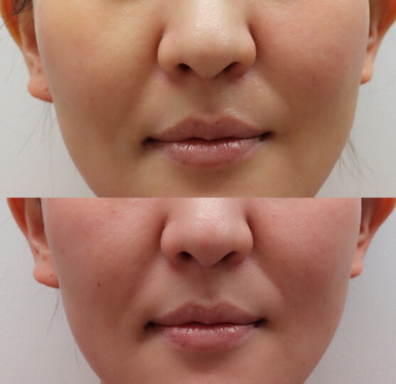 Vビーム直後の状態