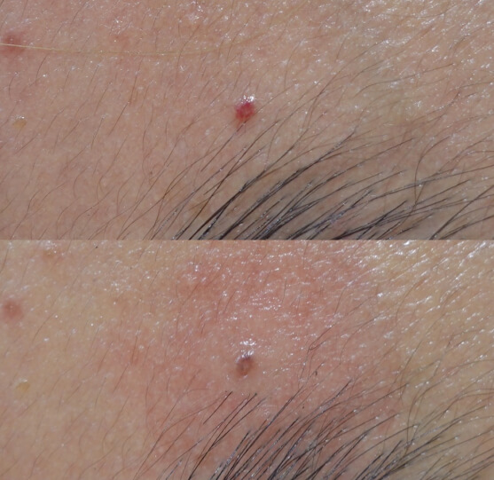 こめかみの老人性血管腫