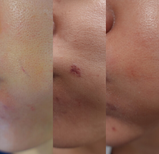 ほほの一部の毛細血管拡張